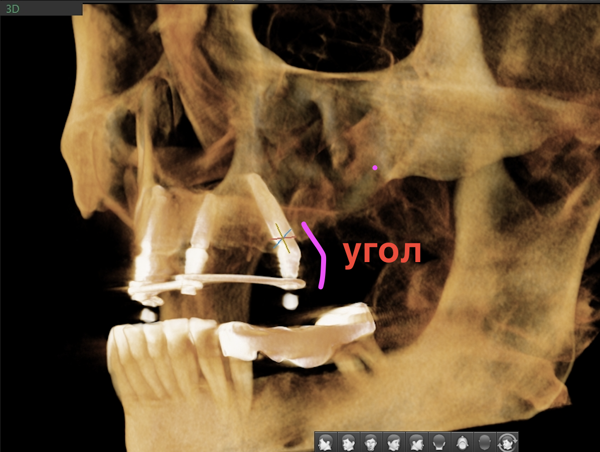 Зубы за день: миф или реальность?
